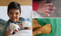 4 yaşındaki Umut’un mucize ameliyatı: 10 parmak açıldı