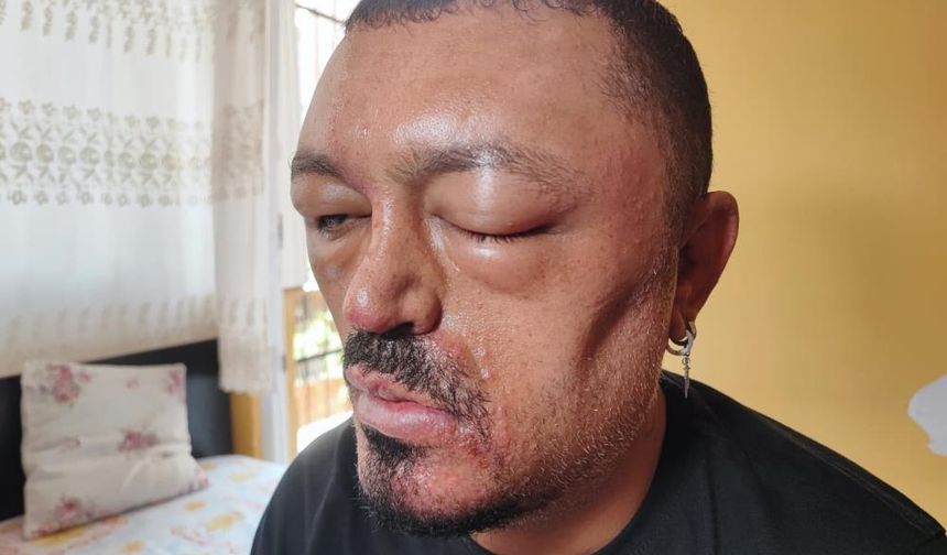 İnternetten Aldığı Şampuanla Gelen Kabus!